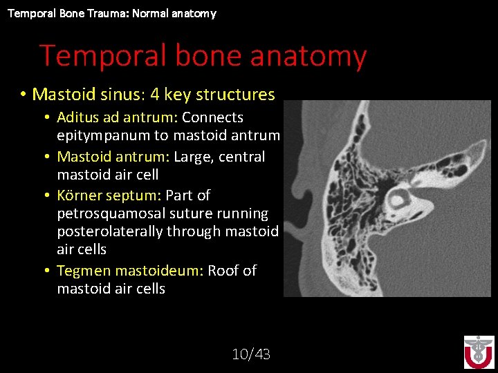 Temporal Bone Trauma: Normal anatomy Temporal bone anatomy • Mastoid sinus: 4 key structures