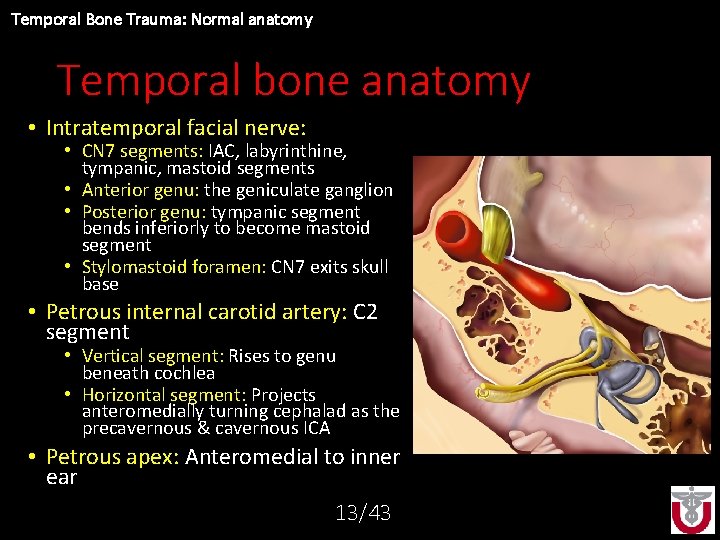Temporal Bone Trauma: Normal anatomy Temporal bone anatomy • Intratemporal facial nerve: • CN