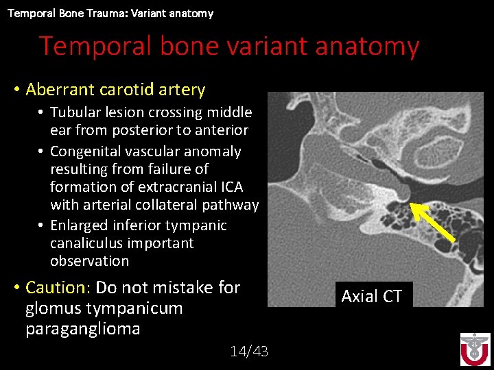 Temporal Bone Trauma: Variant anatomy Temporal bone variant anatomy • Aberrant carotid artery •