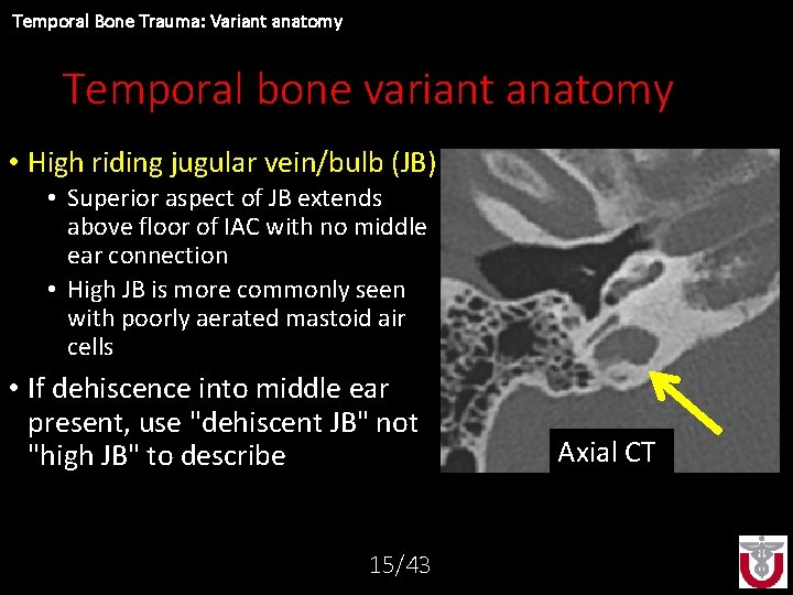 Temporal Bone Trauma: Variant anatomy Temporal bone variant anatomy • High riding jugular vein/bulb