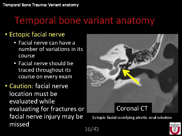 Temporal Bone Trauma: Variant anatomy Temporal bone variant anatomy • Ectopic facial nerve •