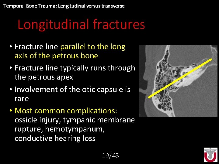 Temporal Bone Trauma: Longitudinal versus transverse Longitudinal fractures • Fracture line parallel to the