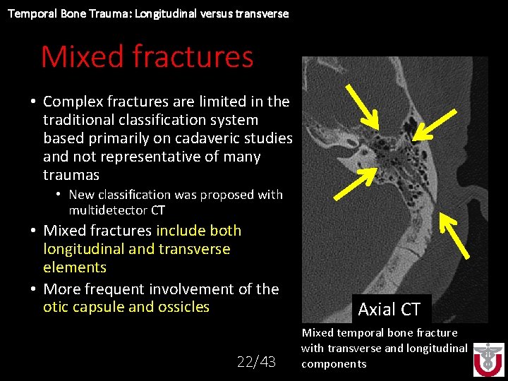 Temporal Bone Trauma: Longitudinal versus transverse Mixed fractures • Complex fractures are limited in