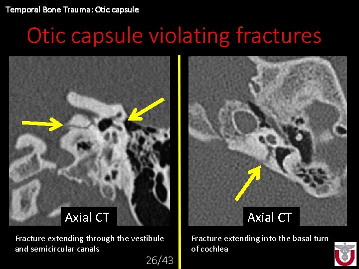 Temporal Bone Trauma: Otic capsule violating fractures Axial CT Axial. CT CTCT Axial Fracture