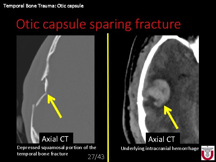 Temporal Bone Trauma: Otic capsule sparing fracture Axial CT Depressed squamosal portion of the