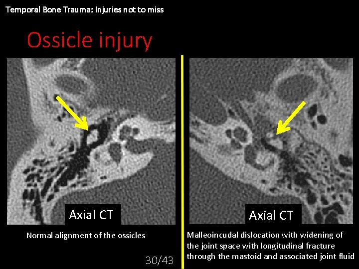 Temporal Bone Trauma: Injuries not to miss Ossicle injury Axial CT Normal alignment of