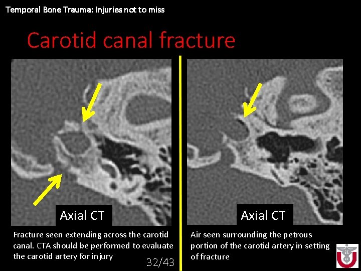 Temporal Bone Trauma: Injuries not to miss Carotid canal fracture Axial CTCT Fracture seen