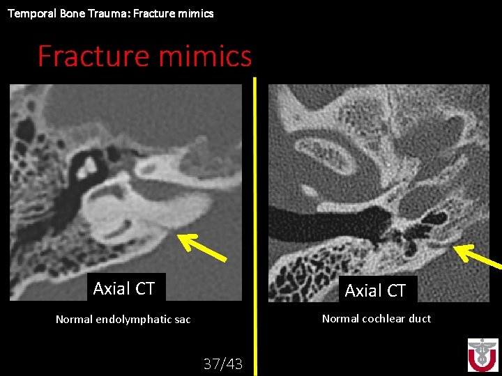 Temporal Bone Trauma: Fracture mimics Axial CT Normal endolymphatic sac Normal cochlear duct 37/43