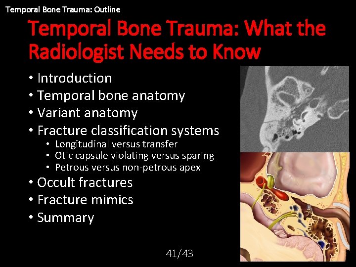 Temporal Bone Trauma: Outline Temporal Bone Trauma: What the Radiologist Needs to Know •