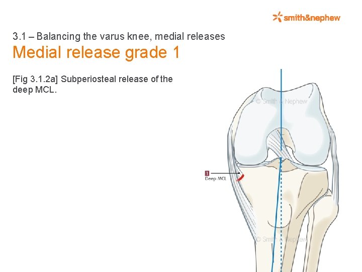 3. 1 – Balancing the varus knee, medial releases Medial release grade 1 [Fig 3. 1.