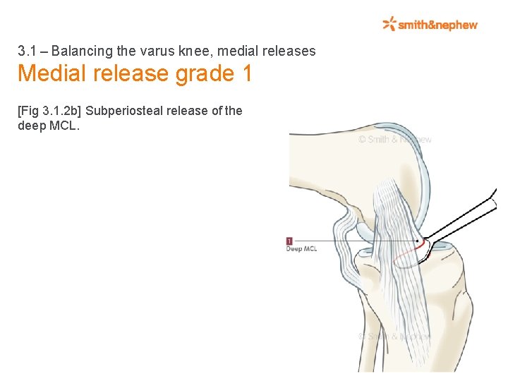 3. 1 – Balancing the varus knee, medial releases Medial release grade 1 [Fig 3. 1.