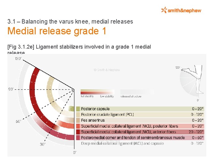 3. 1 – Balancing the varus knee, medial releases Medial release grade 1 [Fig 3. 1.