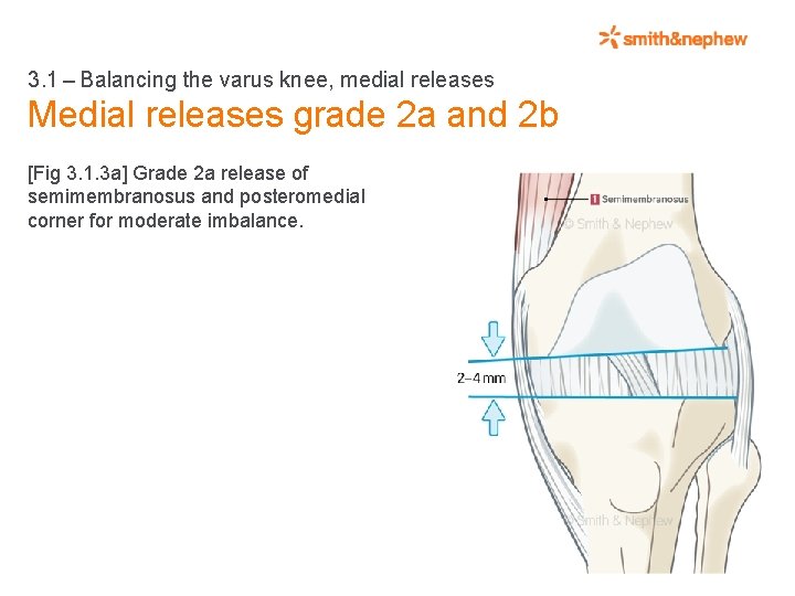 3. 1 – Balancing the varus knee, medial releases Medial releases grade 2 a and 2