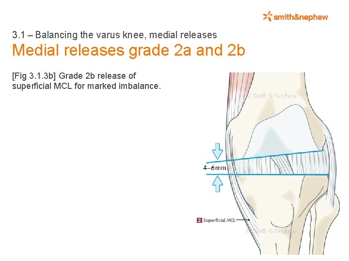 3. 1 – Balancing the varus knee, medial releases Medial releases grade 2 a and 2