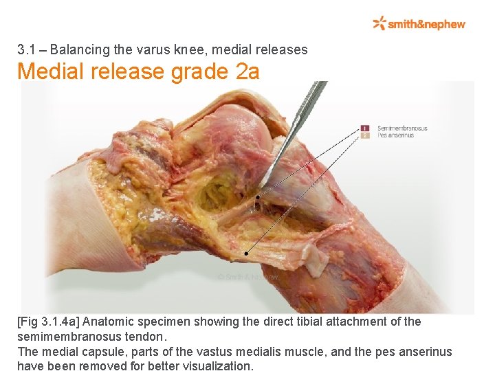 3. 1 – Balancing the varus knee, medial releases Medial release grade 2 a [Fig 3.