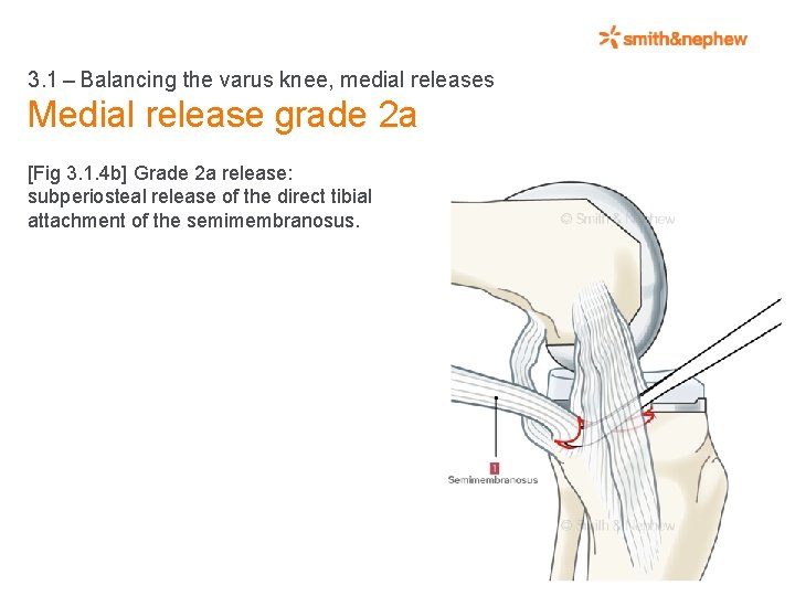 3. 1 – Balancing the varus knee, medial releases Medial release grade 2 a [Fig 3.