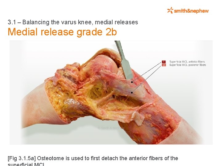 3. 1 – Balancing the varus knee, medial releases Medial release grade 2 b [Fig 3.