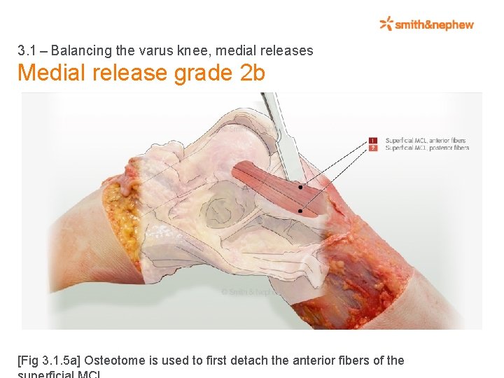 3. 1 – Balancing the varus knee, medial releases Medial release grade 2 b [Fig 3.