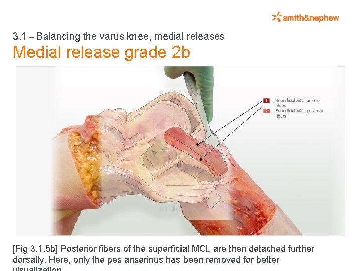 3. 1 – Balancing the varus knee, medial releases Medial release grade 2 b [Fig 3.