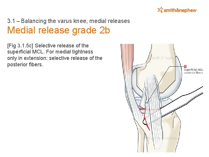 3. 1 – Balancing the varus knee, medial releases Medial release grade 2 b [Fig 3.