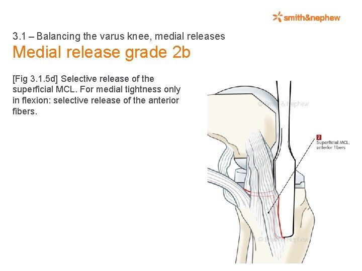 3. 1 – Balancing the varus knee, medial releases Medial release grade 2 b [Fig 3.