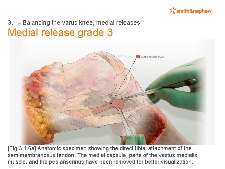 3. 1 – Balancing the varus knee, medial releases Medial release grade 3 [Fig 3. 1.