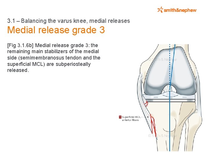 3. 1 – Balancing the varus knee, medial releases Medial release grade 3 [Fig 3. 1.