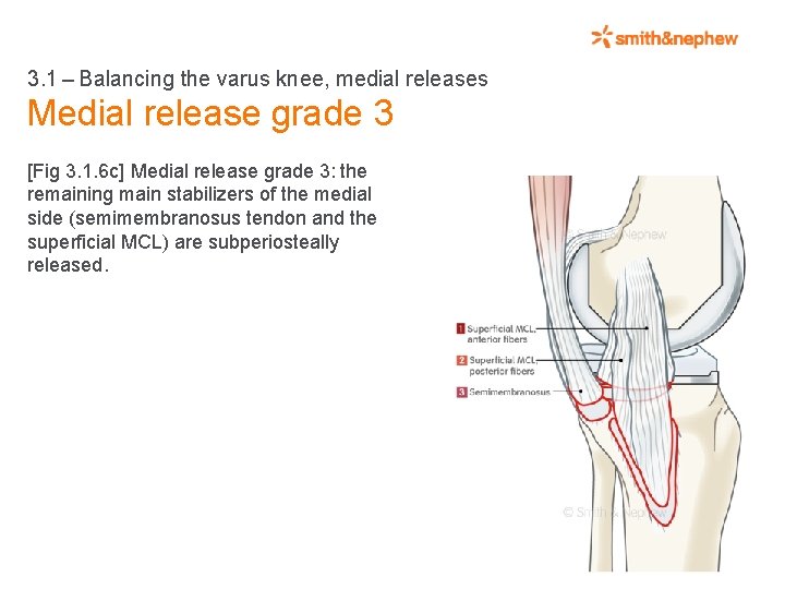 3. 1 – Balancing the varus knee, medial releases Medial release grade 3 [Fig 3. 1.