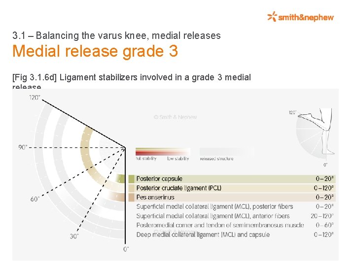 3. 1 – Balancing the varus knee, medial releases Medial release grade 3 [Fig 3. 1.