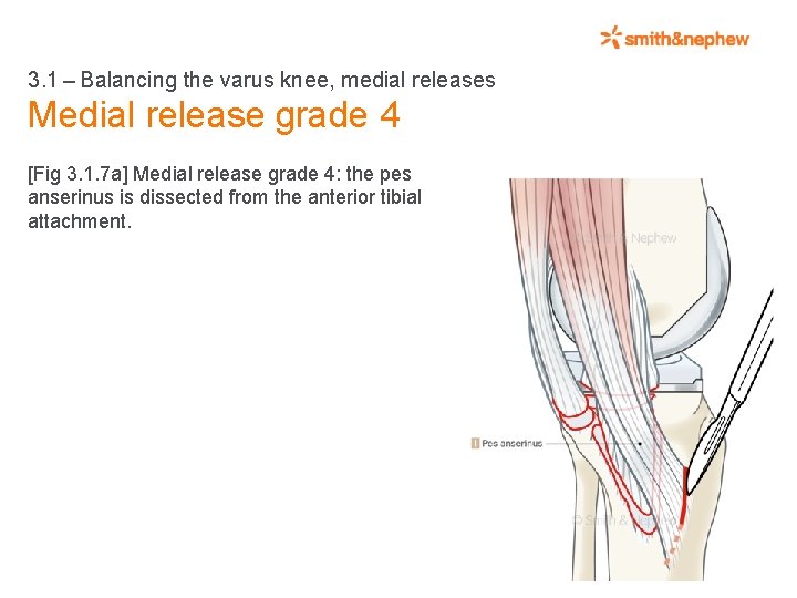 3. 1 – Balancing the varus knee, medial releases Medial release grade 4 [Fig 3. 1.