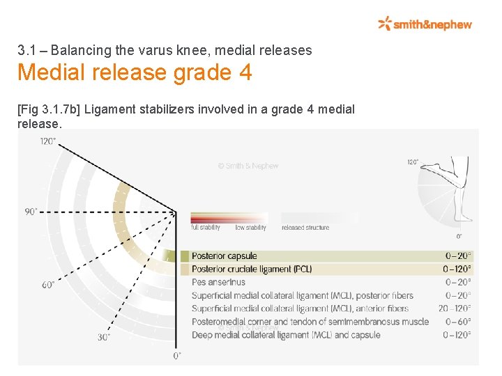 3. 1 – Balancing the varus knee, medial releases Medial release grade 4 [Fig 3. 1.