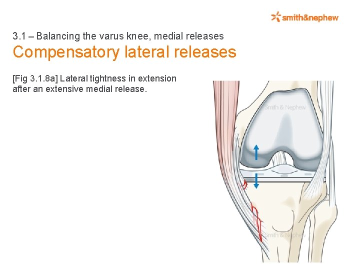 3. 1 – Balancing the varus knee, medial releases Compensatory lateral releases [Fig 3. 1. 8