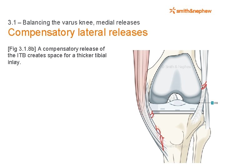 3. 1 – Balancing the varus knee, medial releases Compensatory lateral releases [Fig 3. 1. 8