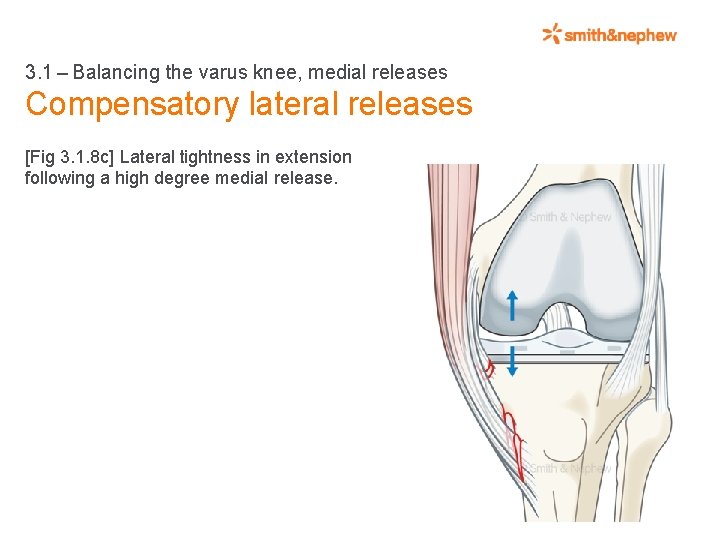 3. 1 – Balancing the varus knee, medial releases Compensatory lateral releases [Fig 3. 1. 8