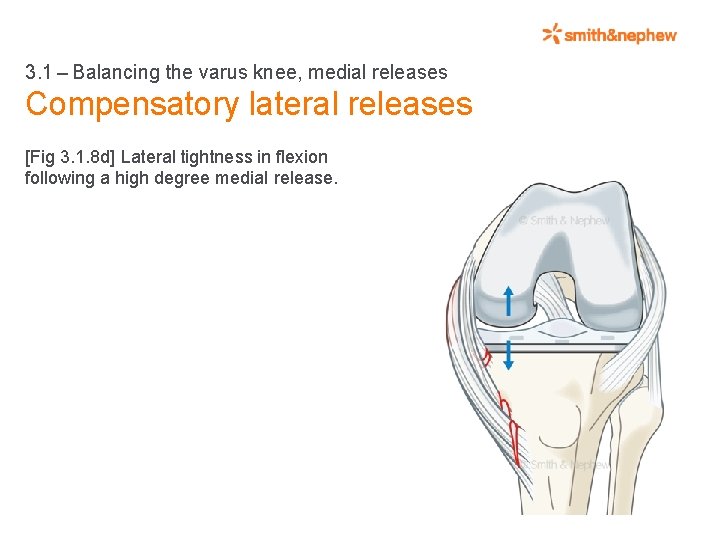 3. 1 – Balancing the varus knee, medial releases Compensatory lateral releases [Fig 3. 1. 8