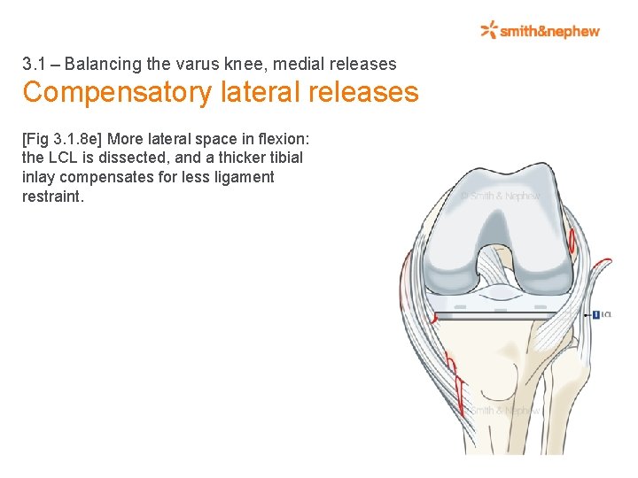 3. 1 – Balancing the varus knee, medial releases Compensatory lateral releases [Fig 3. 1. 8
