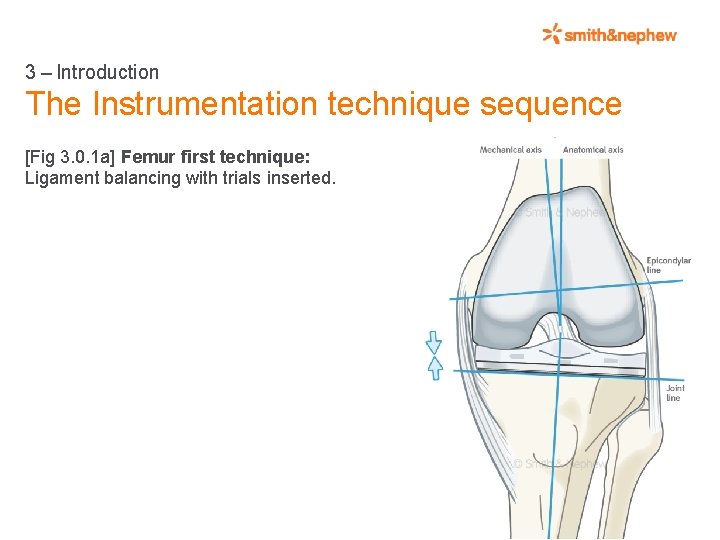 3 – Introduction The Instrumentation technique sequence [Fig 3. 0. 1 a] Femur first technique: Ligament