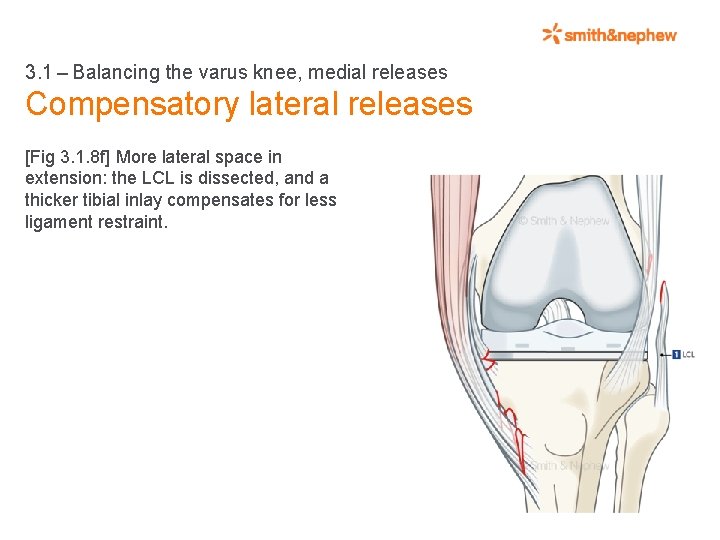 3. 1 – Balancing the varus knee, medial releases Compensatory lateral releases [Fig 3. 1. 8