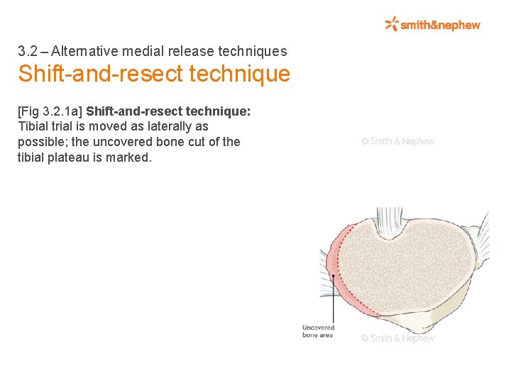 3. 2 – Alternative medial release techniques Shift-and-resect technique [Fig 3. 2. 1 a] Shift-and-resect technique: