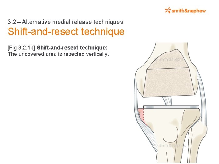 3. 2 – Alternative medial release techniques Shift-and-resect technique [Fig 3. 2. 1 b] Shift-and-resect technique: