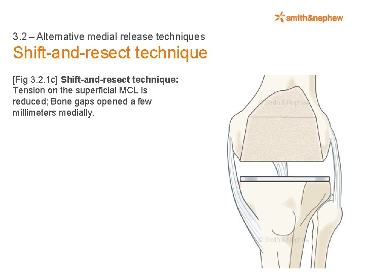 3. 2 – Alternative medial release techniques Shift-and-resect technique [Fig 3. 2. 1 c] Shift-and-resect technique: