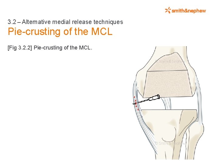 3. 2 – Alternative medial release techniques Pie-crusting of the MCL [Fig 3. 2. 2] Pie-crusting