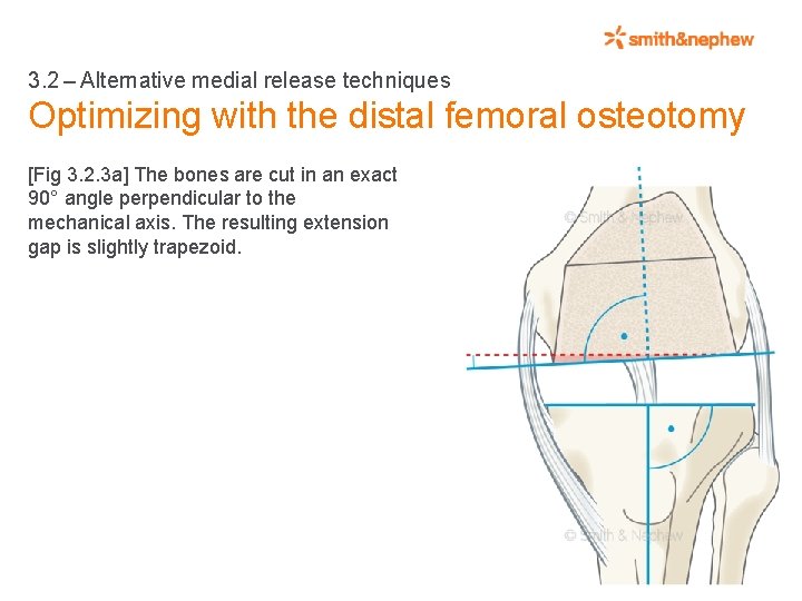 3. 2 – Alternative medial release techniques Optimizing with the distal femoral osteotomy [Fig 3. 2.