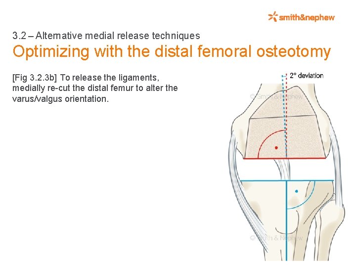 3. 2 – Alternative medial release techniques Optimizing with the distal femoral osteotomy [Fig 3. 2.