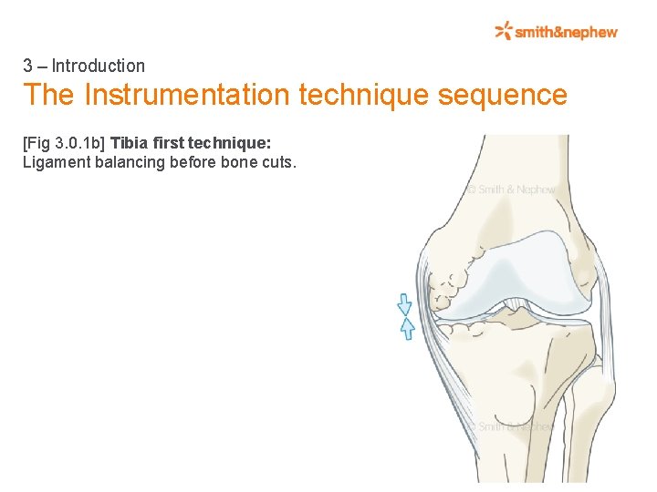3 – Introduction The Instrumentation technique sequence [Fig 3. 0. 1 b] Tibia first technique: Ligament