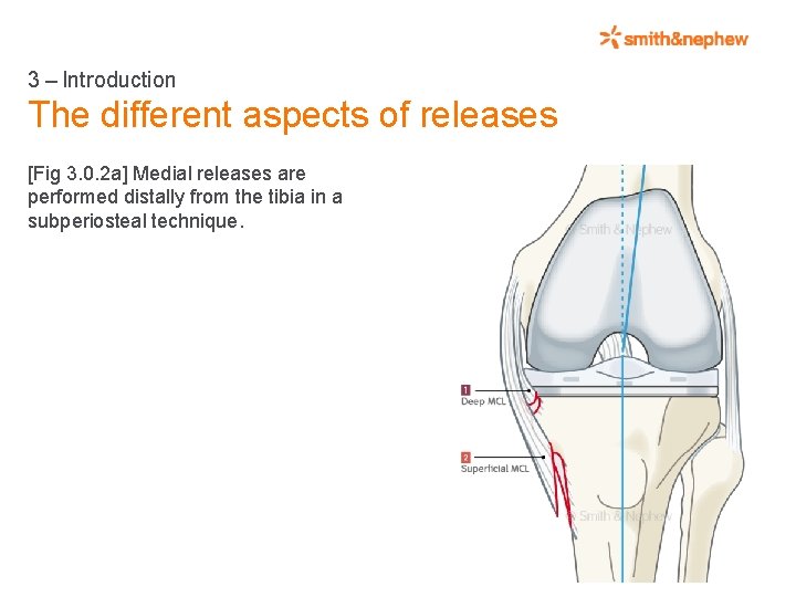 3 – Introduction The different aspects of releases [Fig 3. 0. 2 a] Medial releases are