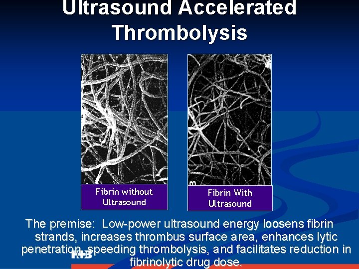 Ultrasound Accelerated Thrombolysis Fibrin without Ultrasound Fibrin With Ultrasound The premise: Low-power ultrasound energy