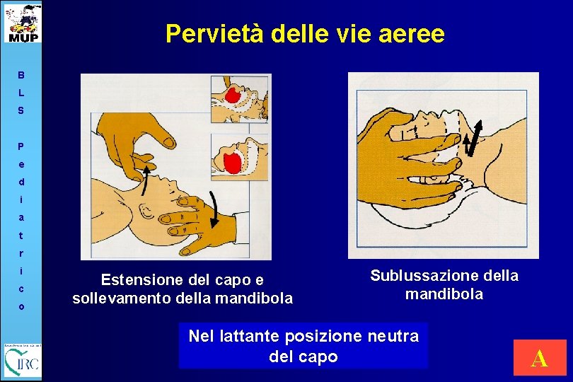 Pervietà delle vie aeree B L S P e d i a t r