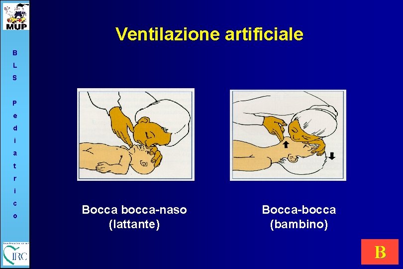 Ventilazione artificiale B L S P e d i a t r i c