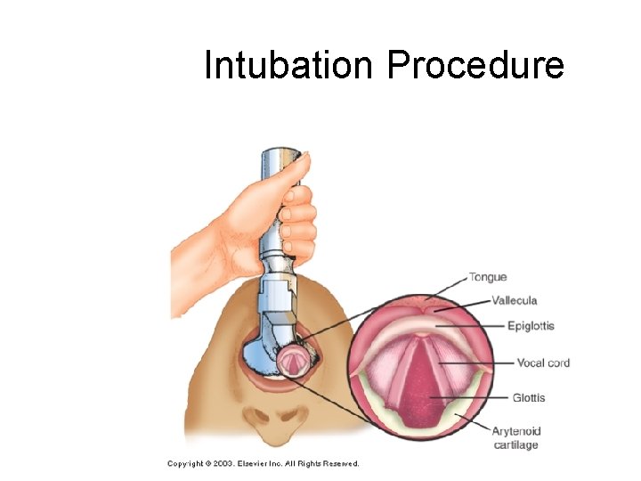 Intubation Procedure 